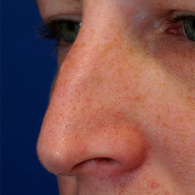 Before bossa repair rhinoplasty