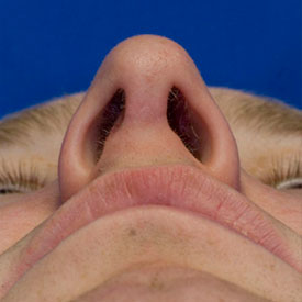 After base rhinoplasty photo