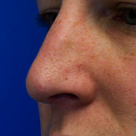 After bossa rhinoplasty photo