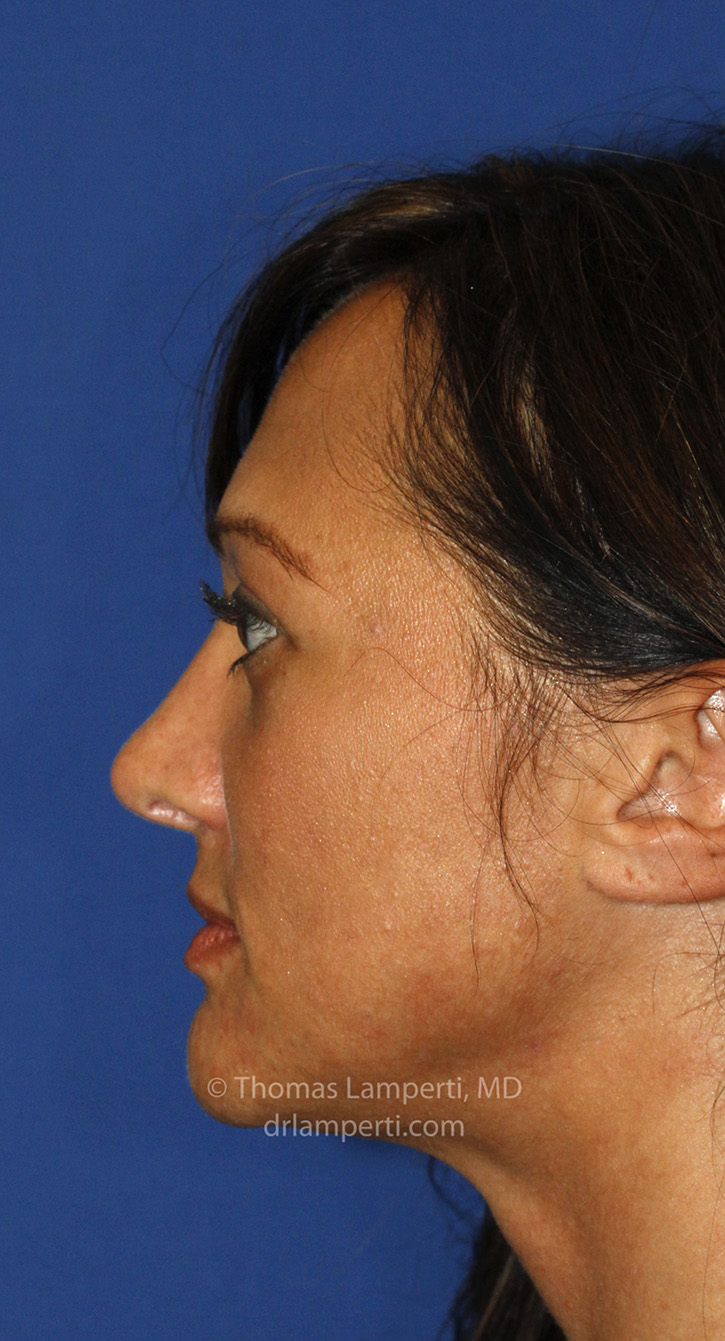 Rhinoplasty After L Profile