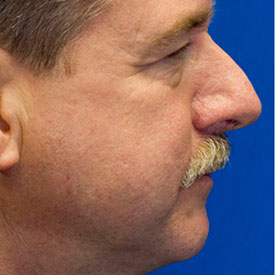 Before profile rhinoplasty photo