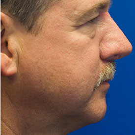 After profile rhinoplasty photo