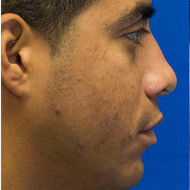 After profile rhinoplasty photo