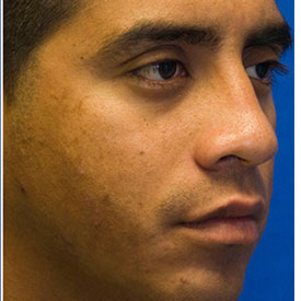 After rhinoplasty photo