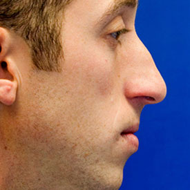 Before profile rhinoplasty photo