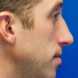 After profile rhinoplasty photo