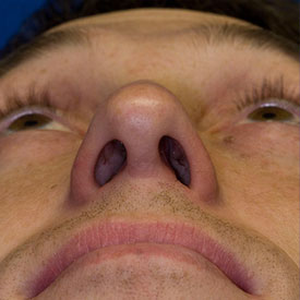 After base rhinoplasty photo