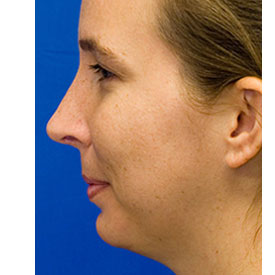 After profile rhinoplasty photo