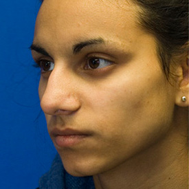 Before Ethnic rhinoplasty oblique