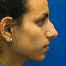 Before Ethnic rhinoplasty profile