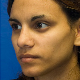 After Ethnic rhinoplasty oblique