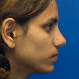 After Ethnic rhinoplasty profile