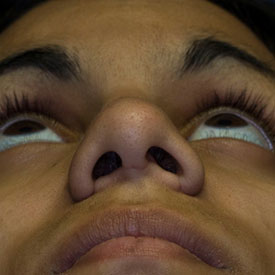 After asymmetric nostril repair