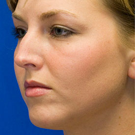 Before dorsal hump rhinoplasty