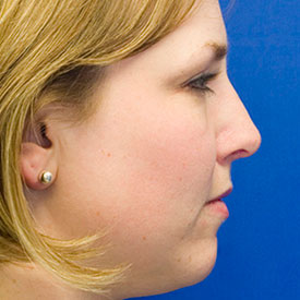 After dorsal hump rhinoplasty