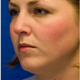 After dorsal hump rhinoplasty