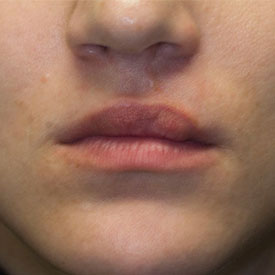 After cleft lip revision