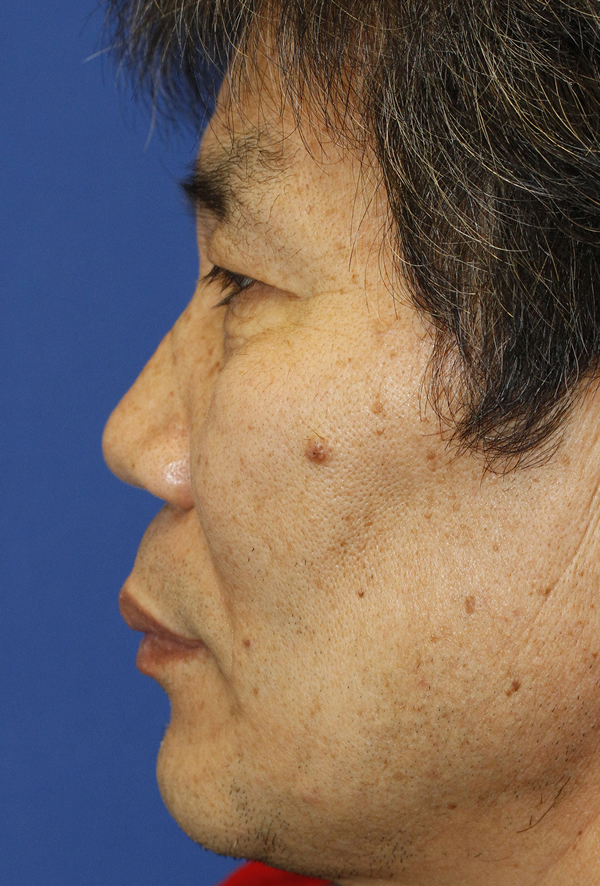 After Saddlenose Rhinoplasty