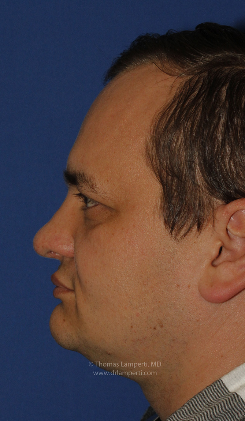 Rhinoplasty After L Profile