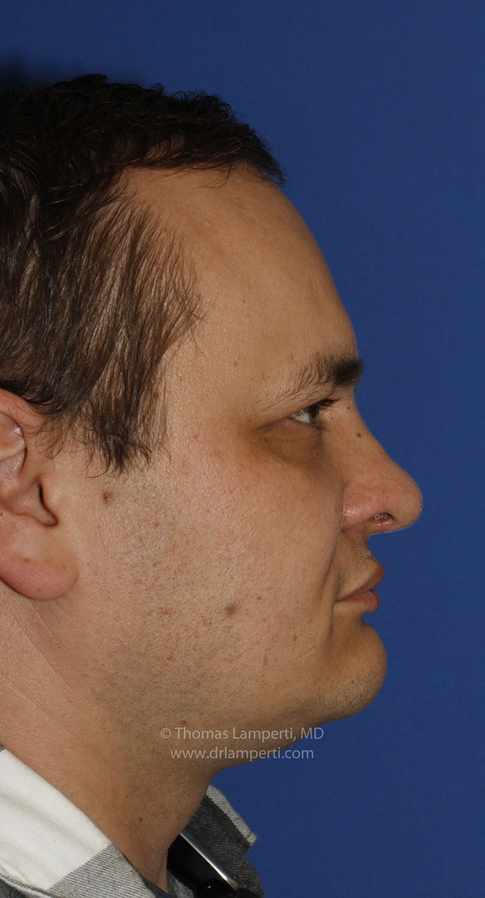 Rhinoplasty After R Profile