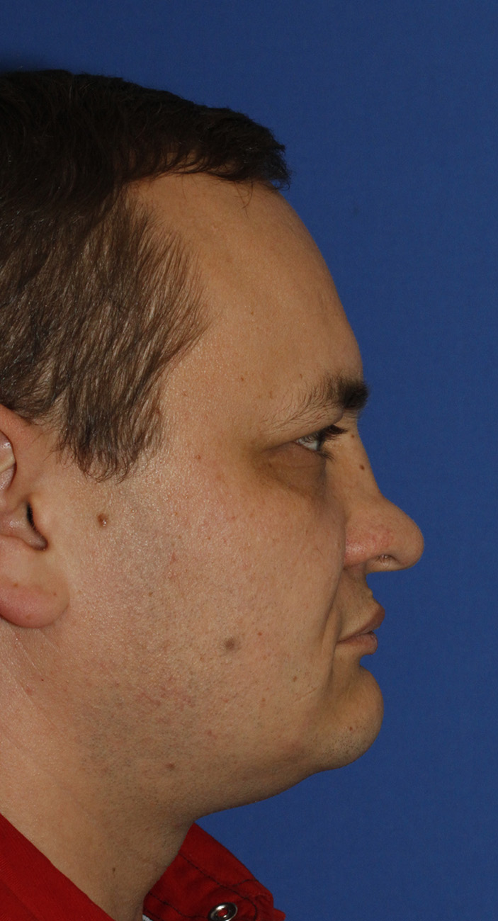 Rhinoplasty Before R Profile