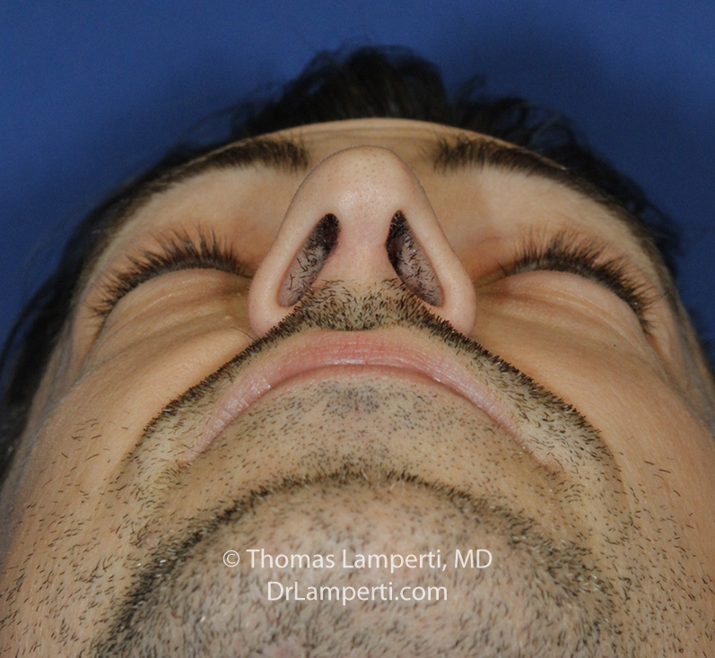 Rhinoplasty After Base