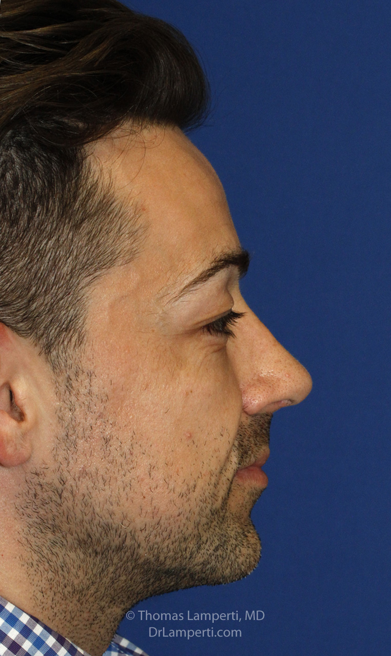 Rhinoplasty After R Profile