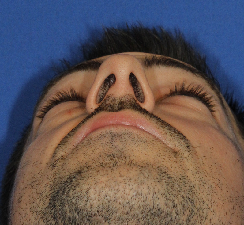 Rhinoplasty Before Base