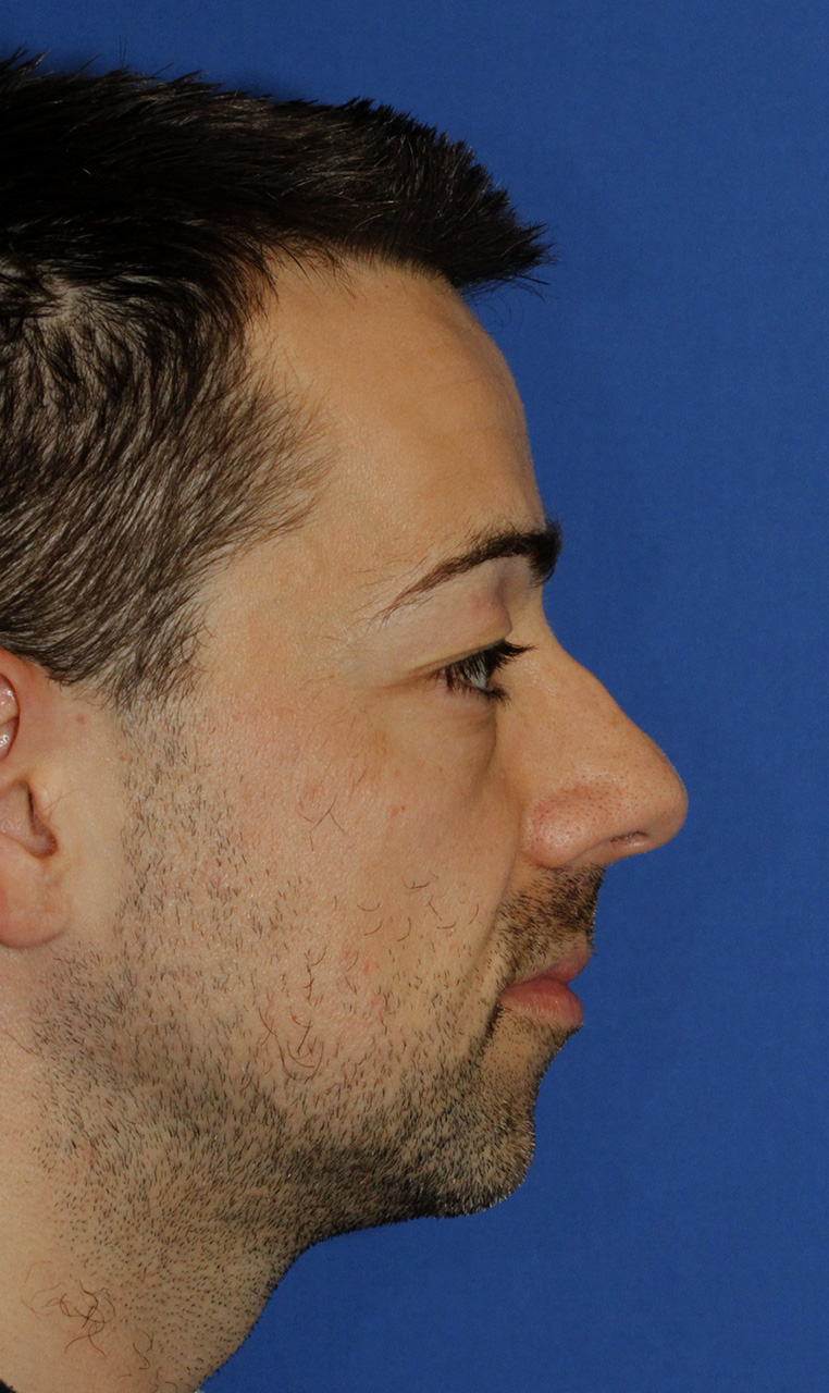 Rhinoplasty Before R Profile