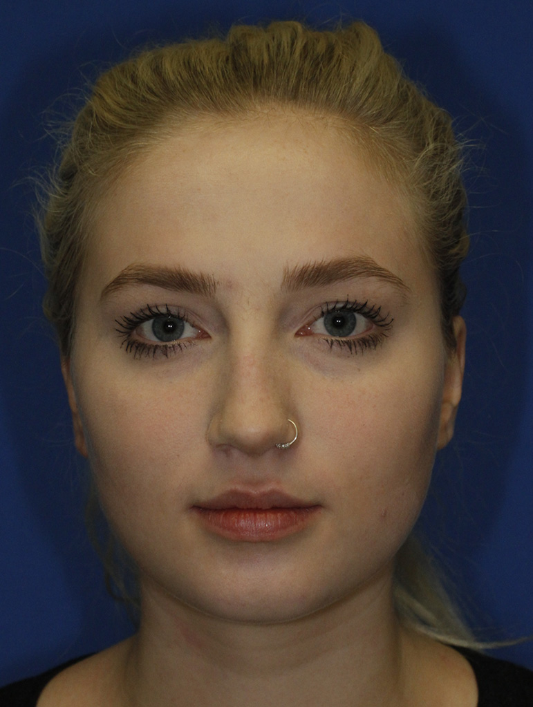 Rhinoplasty Before Frontal