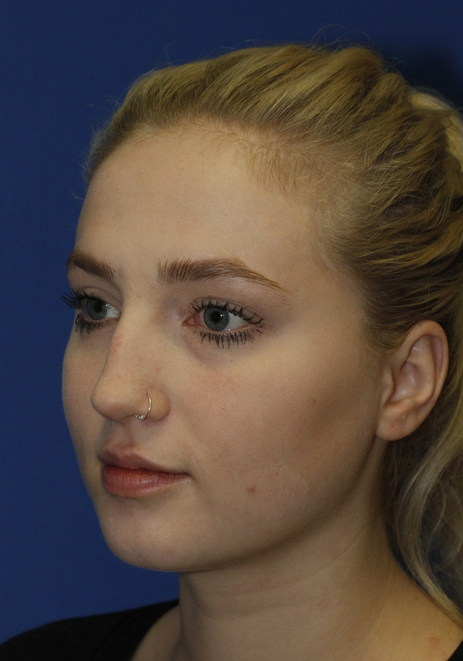 Rhinoplasty Before L Oblique