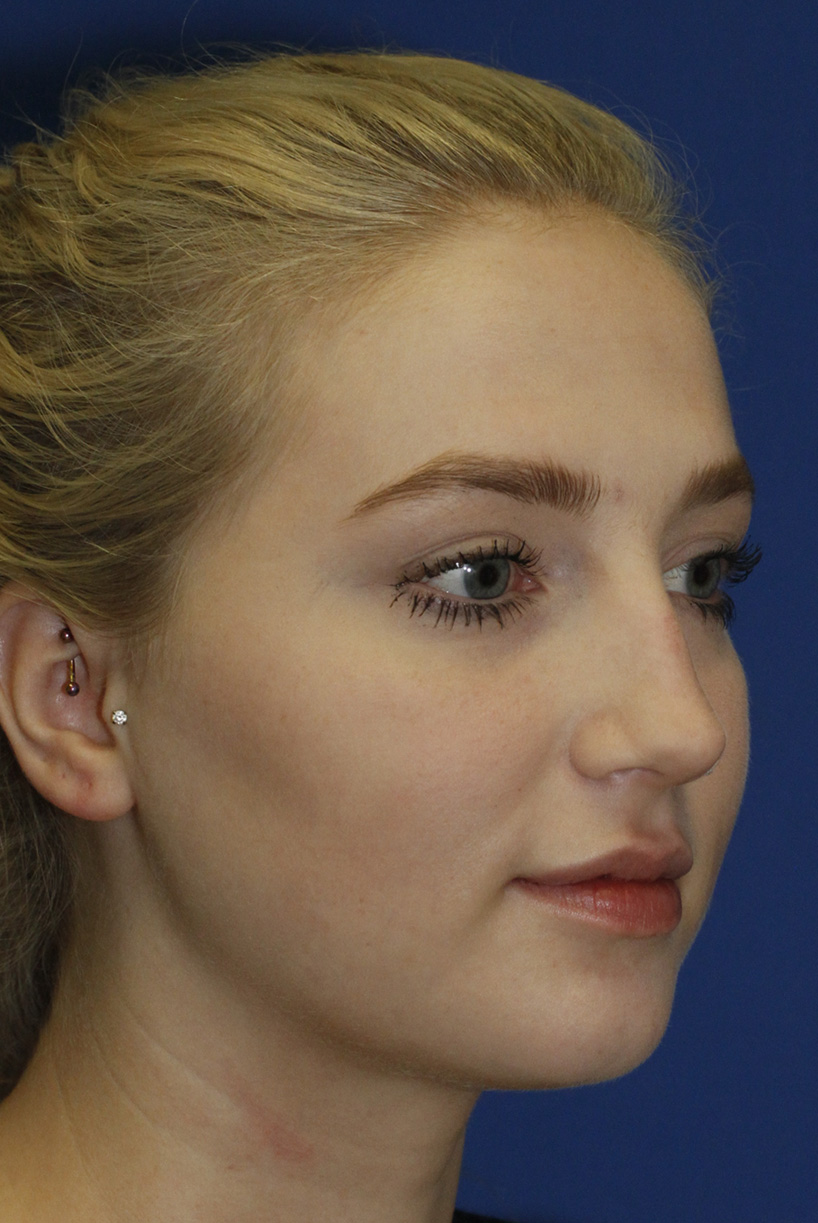 Rhinoplasty Before R Oblique