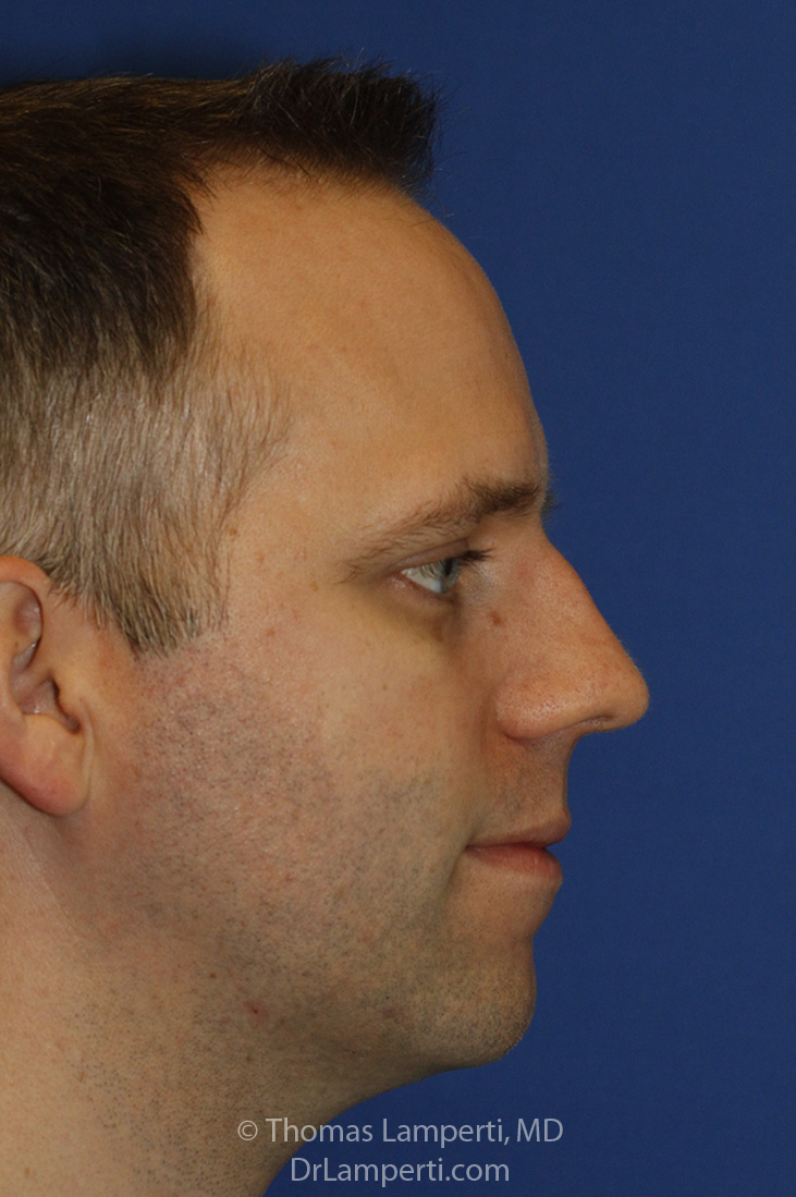 Rhinoplasty After R Profile