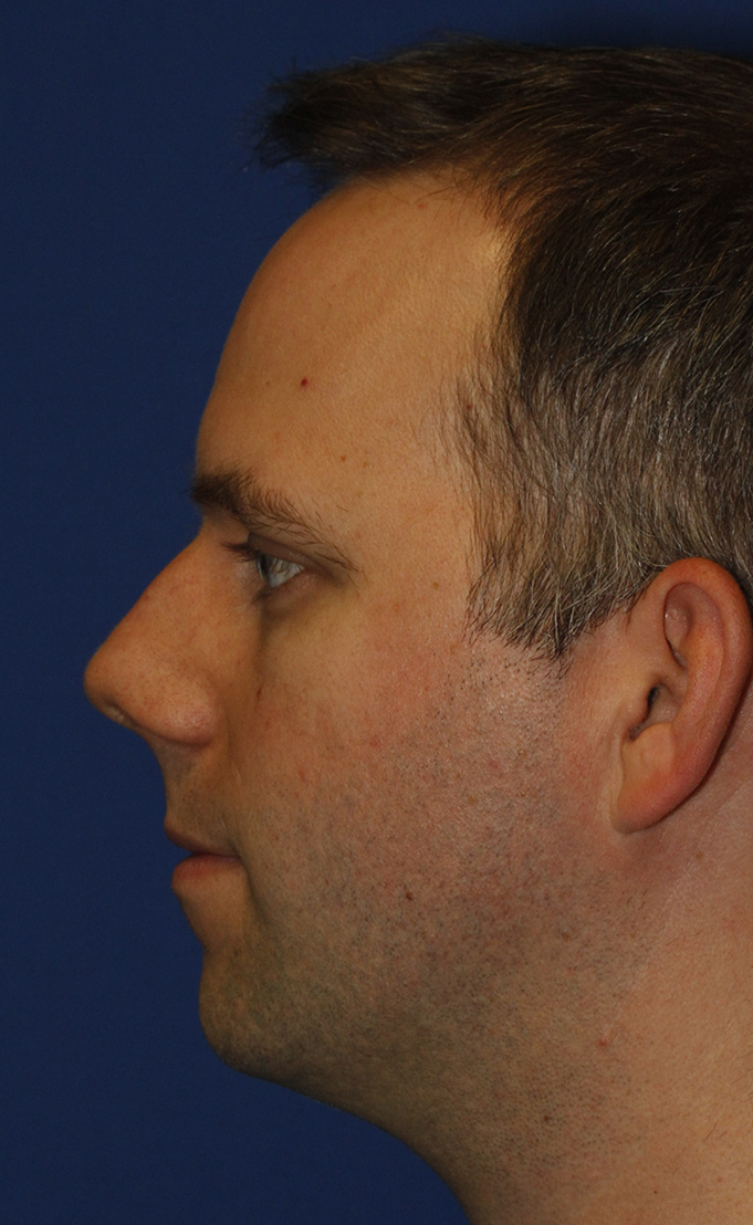 Rhinoplasty Before L Profile