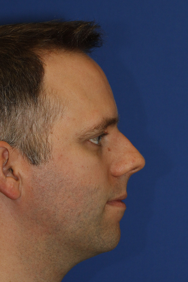 Rhinoplasty Before R Profile