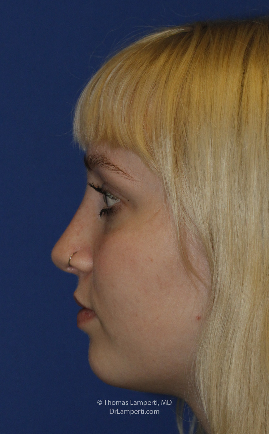 Rhinoplasty After L Profile