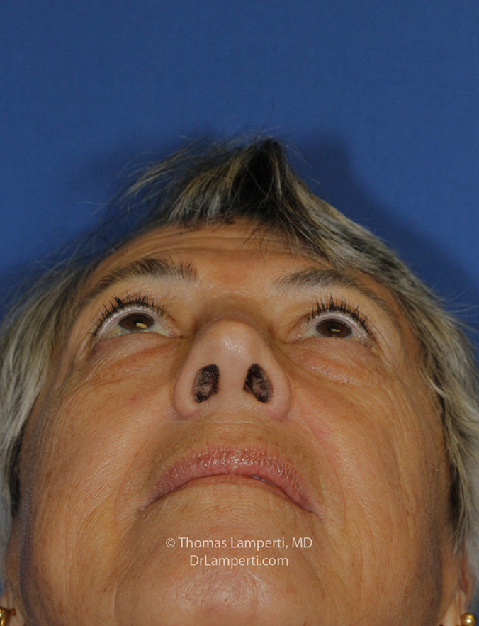 Rhinoplasty After Base