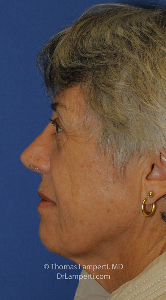 Rhinoplasty After L Profile