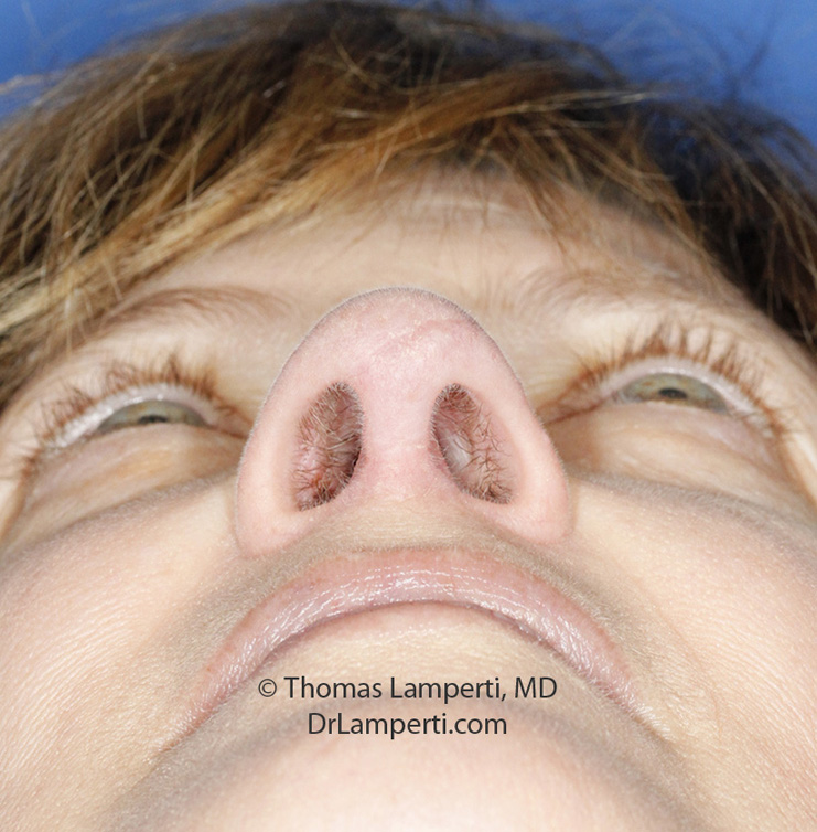 Rhinoplasty After Base