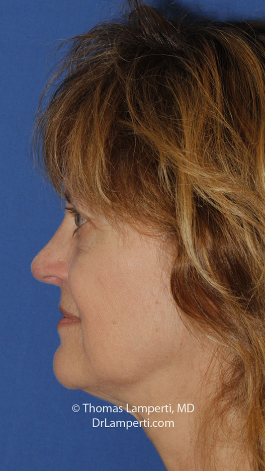 Rhinoplasty After L Profile