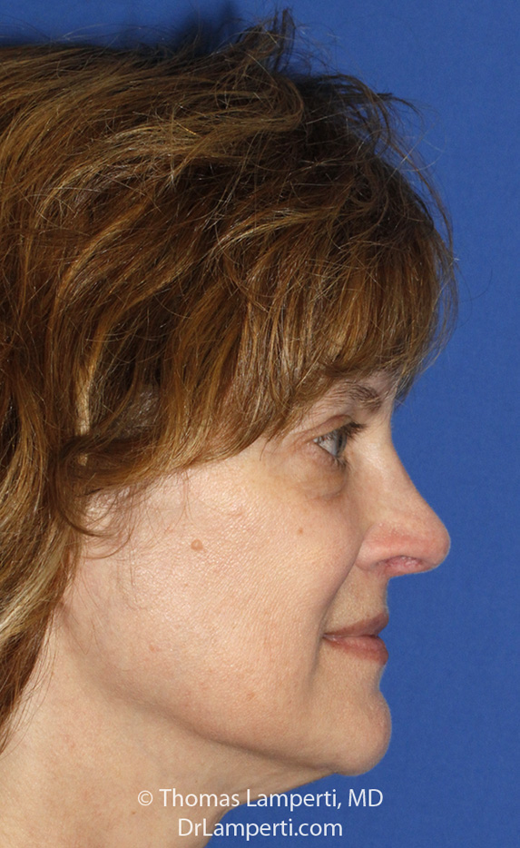 Rhinoplasty After R Profile