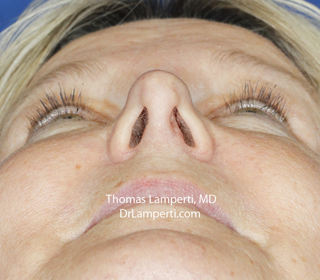 Rhinoplasty After Base