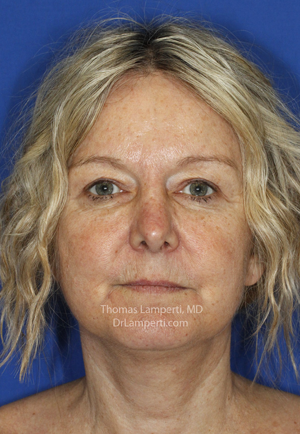Rhinoplasty After Frontal