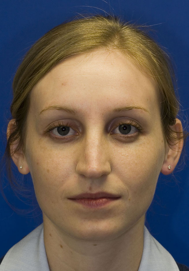 Before Rhinoplasty photo