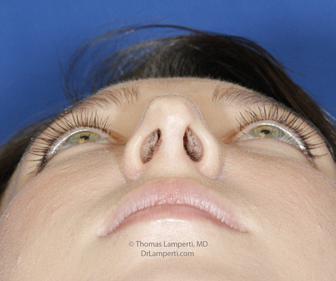 Rhinoplasty After Base