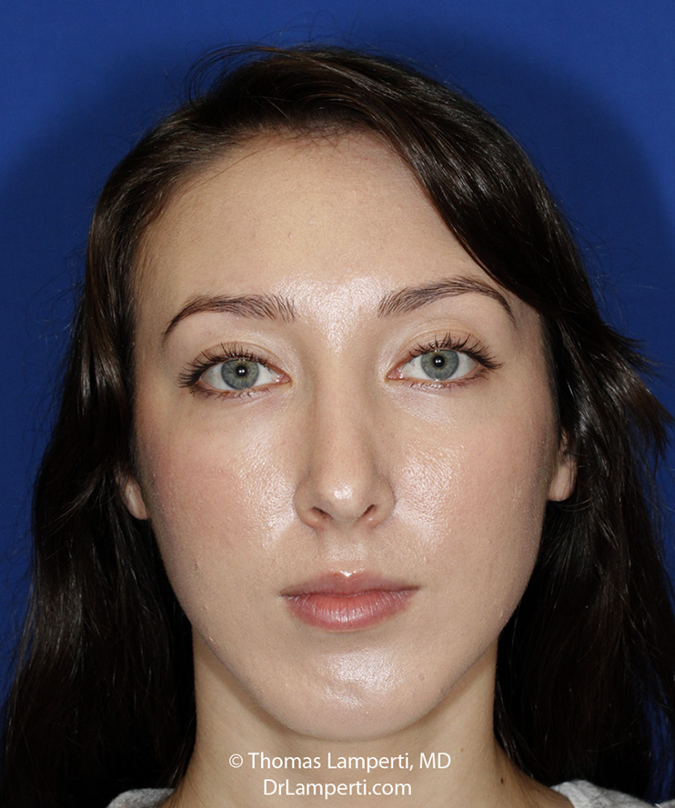 Rhinoplasty After Frontal