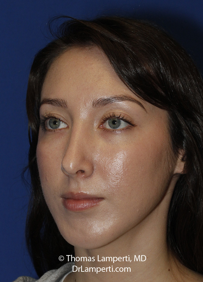 Rhinoplasty After L Oblique