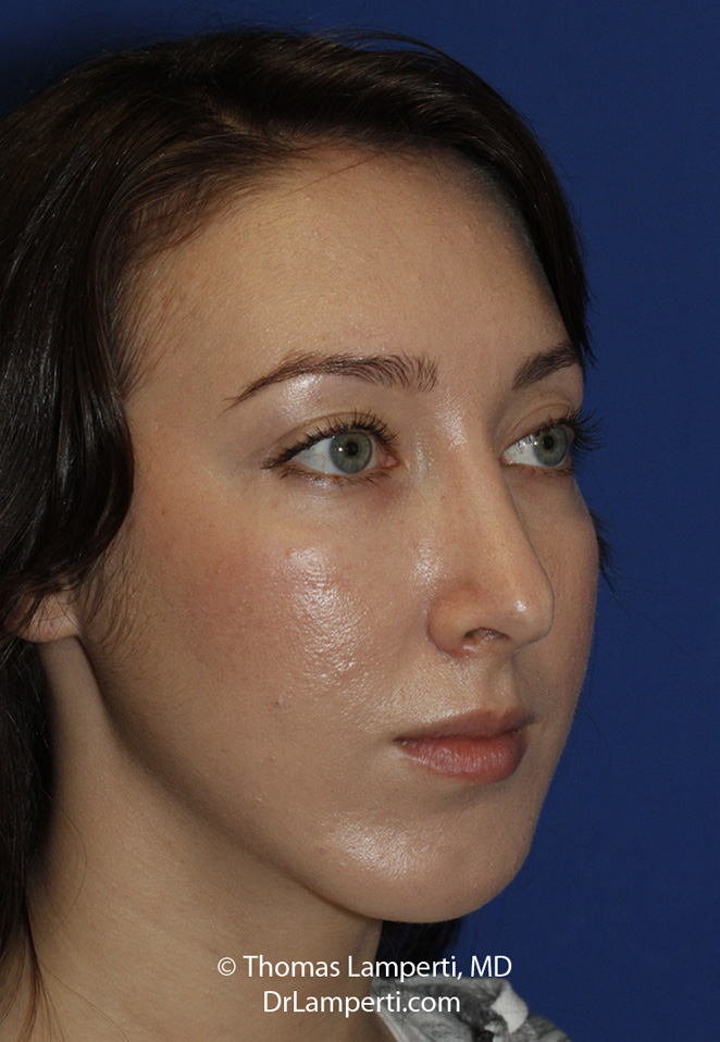 Rhinoplasty After R Oblique