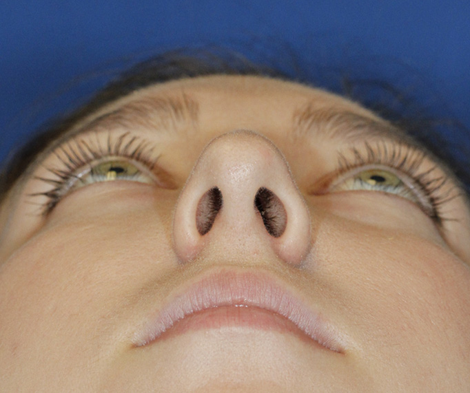 Rhinoplasty Before Base