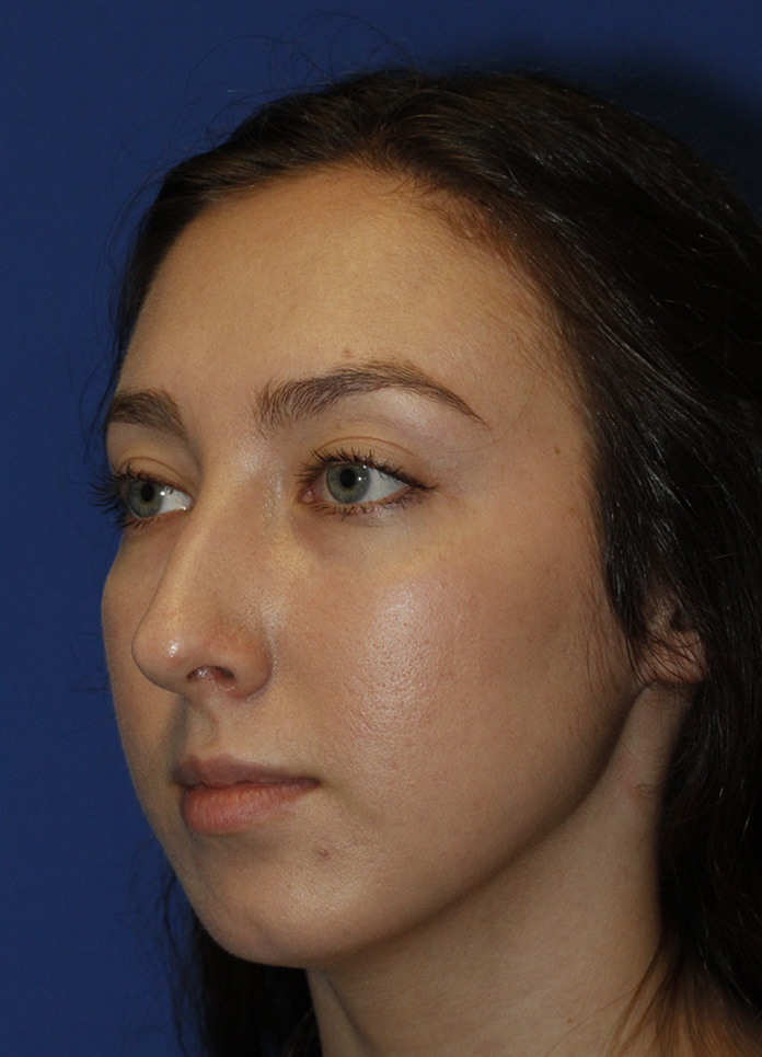 Rhinoplasty Before L Oblique